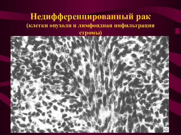 Недифференцированный рак (клетки опухоли и лимфоидная инфильтрация стромы)