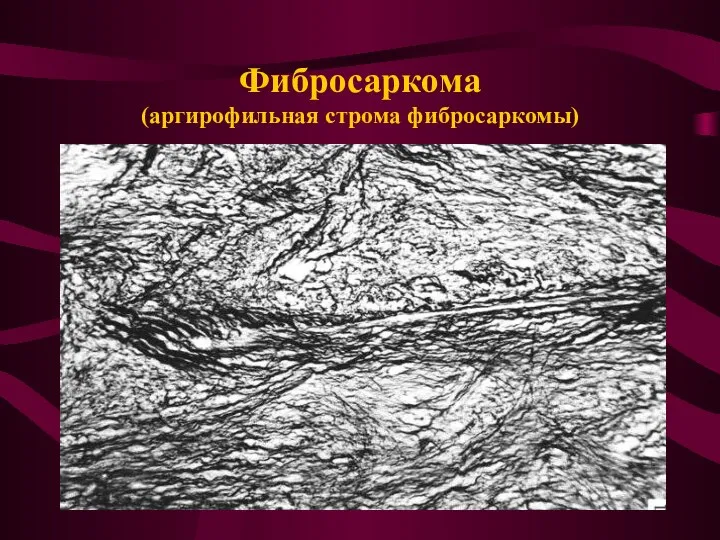 Фибросаркома (аргирофильная строма фибросаркомы)