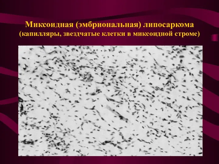 Миксоидная (эмбриональная) липосаркома (капилляры, звездчатые клетки в миксоидной строме)