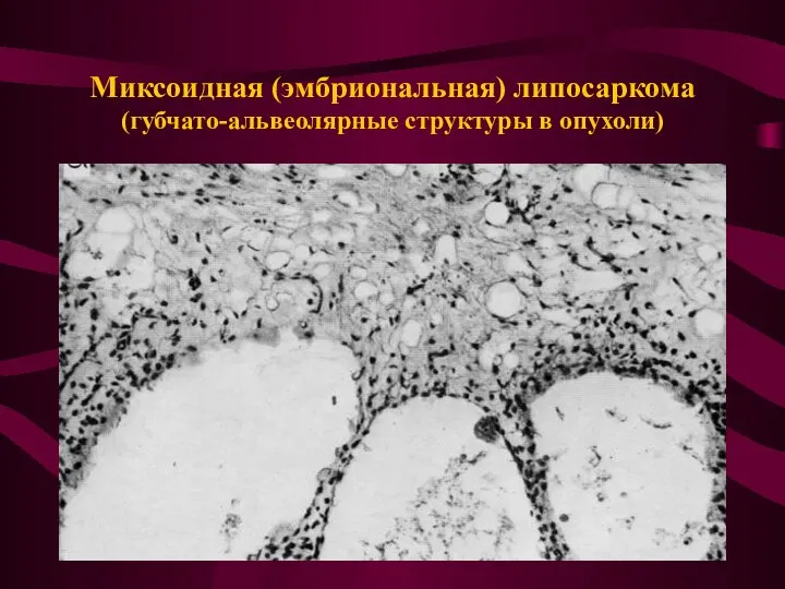 Миксоидная (эмбриональная) липосаркома (губчато-альвеолярные структуры в опухоли)