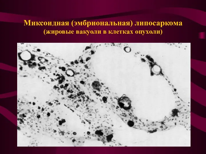 Миксоидная (эмбриональная) липосаркома (жировые вакуоли в клетках опухоли)