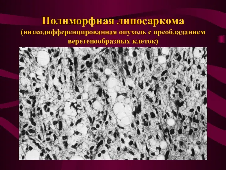 Полиморфная липосаркома (низкодифференцированная опухоль с преобладанием веретенообразных клеток)