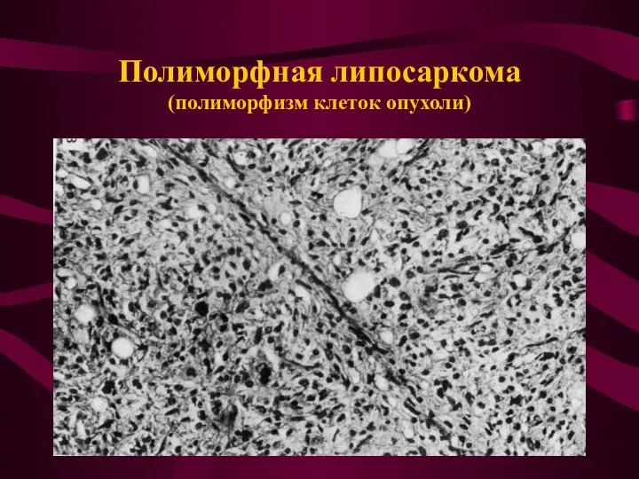 Полиморфная липосаркома (полиморфизм клеток опухоли)