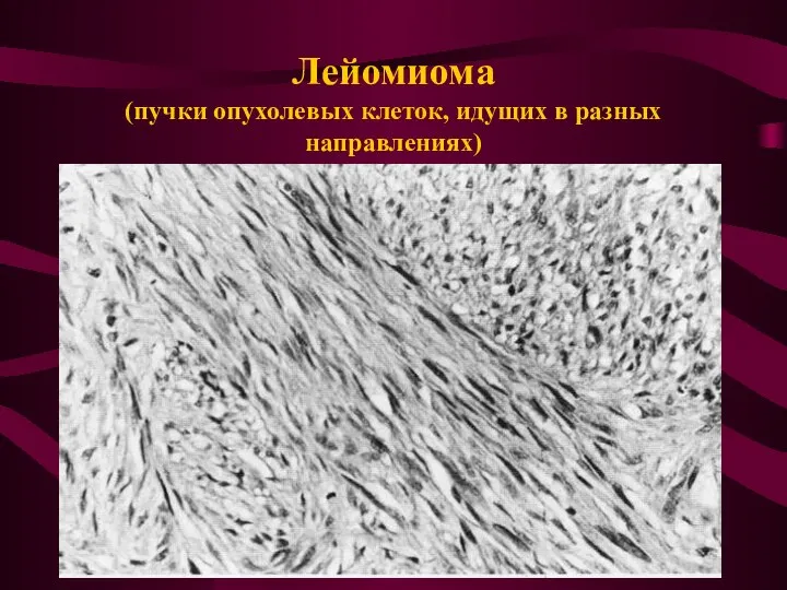Лейомиома (пучки опухолевых клеток, идущих в разных направлениях)