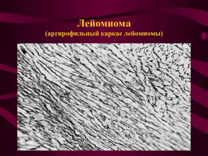 Лейомиома (аргирофильный каркас лейомиомы)