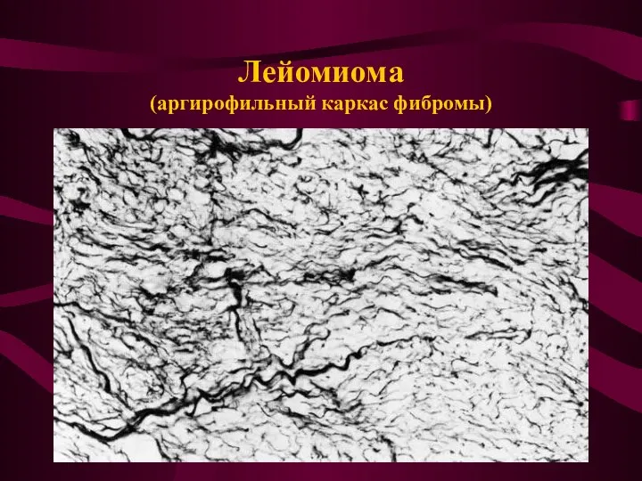 Лейомиома (аргирофильный каркас фибромы)