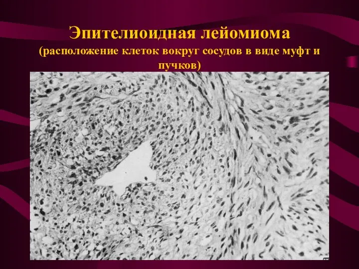 Эпителиоидная лейомиома (расположение клеток вокруг сосудов в виде муфт и пучков)