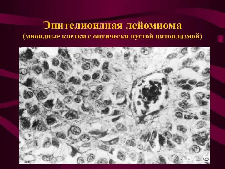 Эпителиоидная лейомиома (миоидные клетки с оптически пустой цитоплазмой)