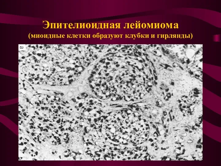 Эпителиоидная лейомиома (миоидные клетки образуют клубки и гирлянды)