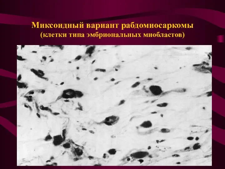 Миксоидный вариант рабдомиосаркомы (клетки типа эмбриональных миобластов)