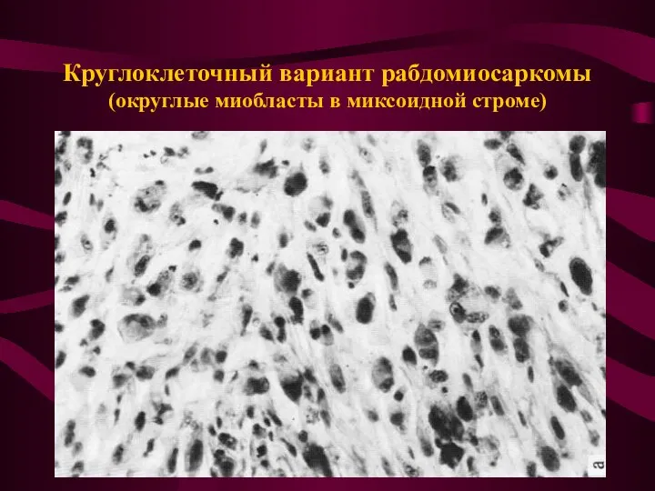 Круглоклеточный вариант рабдомиосаркомы (округлые миобласты в миксоидной строме)