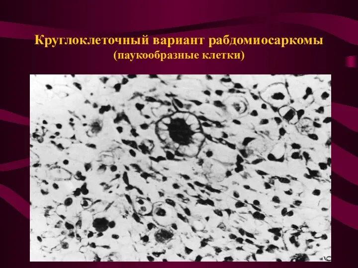 Круглоклеточный вариант рабдомиосаркомы (паукообразные клетки)
