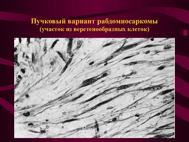 Пучковый вариант рабдомиосаркомы (участок из веретенообразных клеток)