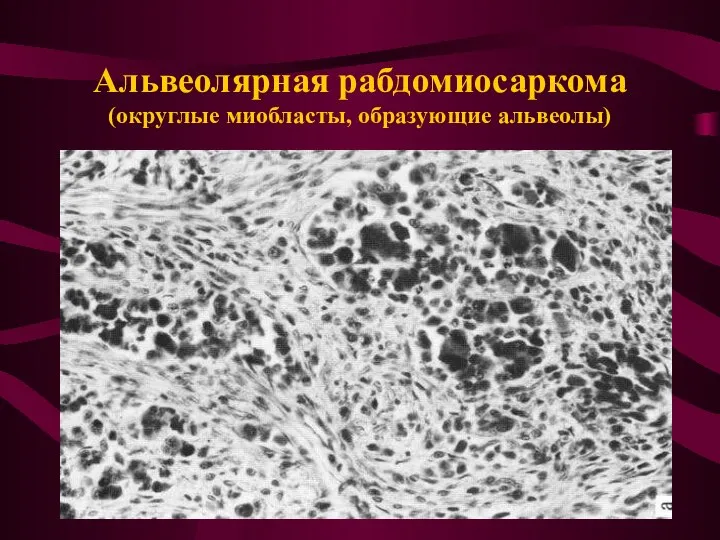 Альвеолярная рабдомиосаркома (округлые миобласты, образующие альвеолы)