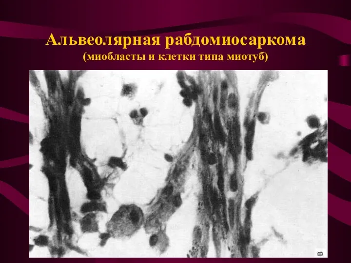 Альвеолярная рабдомиосаркома (миобласты и клетки типа миотуб)