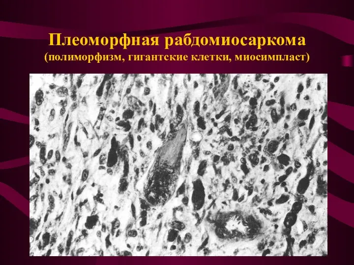 Плеоморфная рабдомиосаркома (полиморфизм, гигантские клетки, миосимпласт)