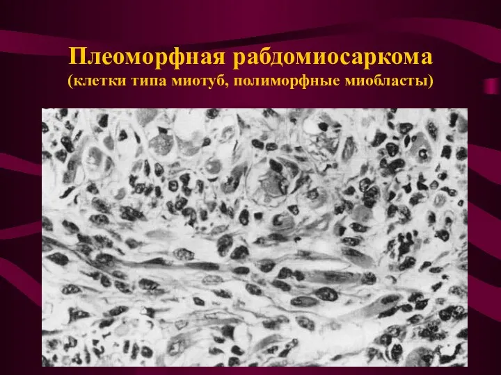 Плеоморфная рабдомиосаркома (клетки типа миотуб, полиморфные миобласты)