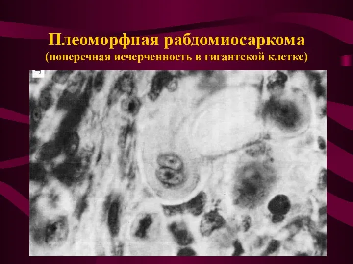 Плеоморфная рабдомиосаркома (поперечная исчерченность в гигантской клетке)