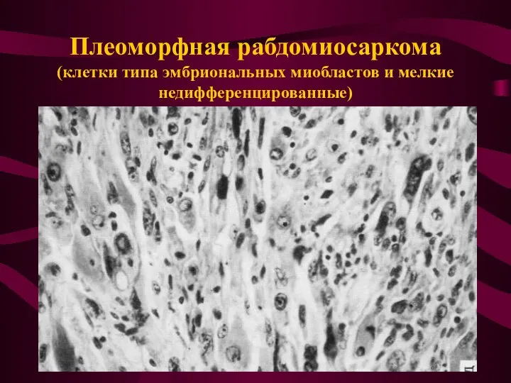 Плеоморфная рабдомиосаркома (клетки типа эмбриональных миобластов и мелкие недифференцированные)