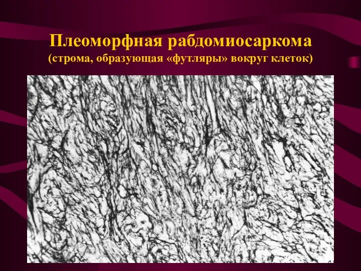 Плеоморфная рабдомиосаркома (строма, образующая «футляры» вокруг клеток)