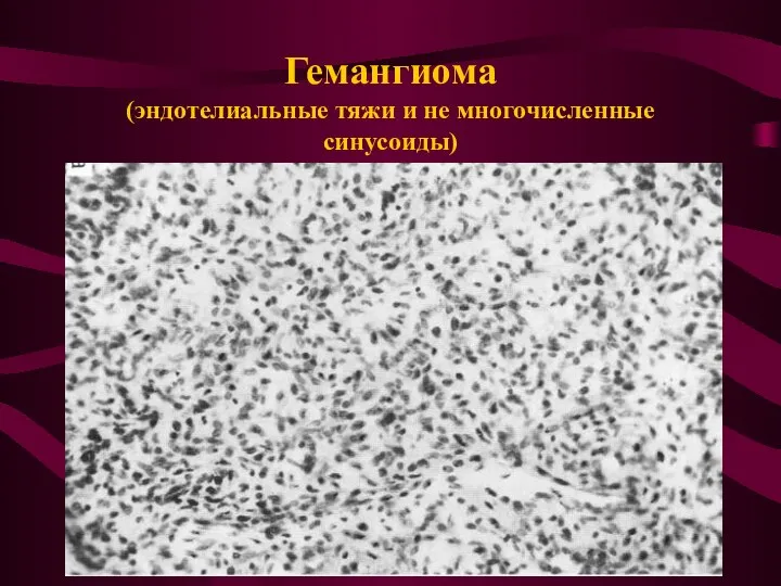 Гемангиома (эндотелиальные тяжи и не многочисленные синусоиды)