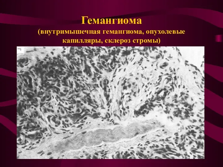 Гемангиома (внутримышечная гемангиома, опухолевые капилляры, склероз стромы)