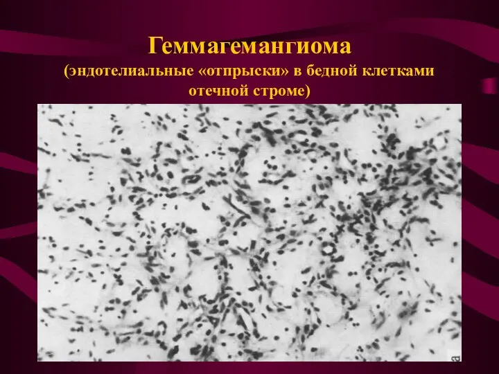 Геммагемангиома (эндотелиальные «отпрыски» в бедной клетками отечной строме)