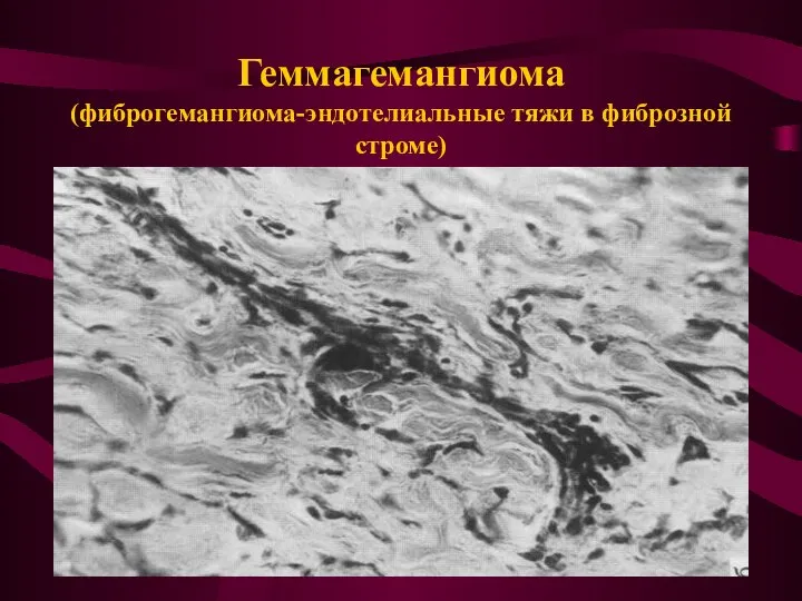Геммагемангиома (фиброгемангиома-эндотелиальные тяжи в фиброзной строме)