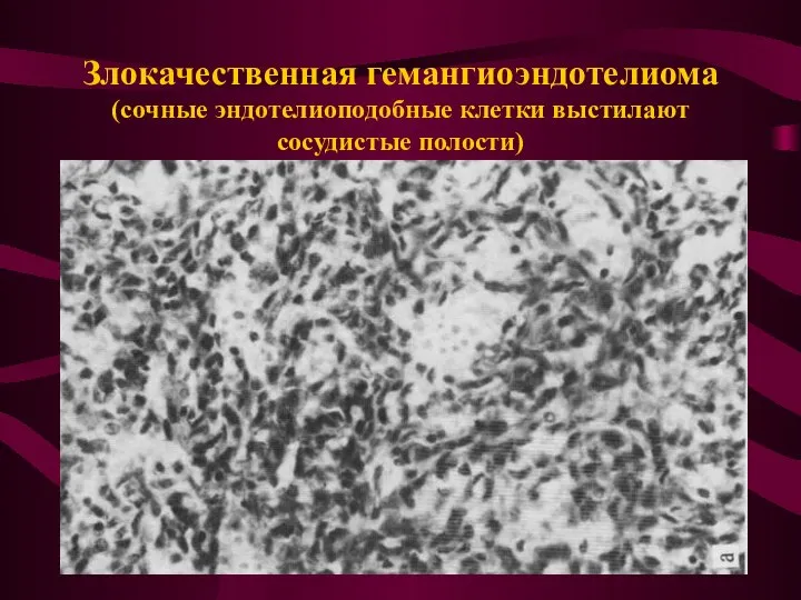 Злокачественная гемангиоэндотелиома (сочные эндотелиоподобные клетки выстилают сосудистые полости)