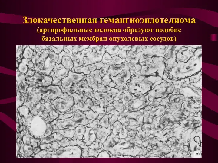 Злокачественная гемангиоэндотелиома (аргирофильные волокна образуют подобие базальных мембран опухолевых сосудов)