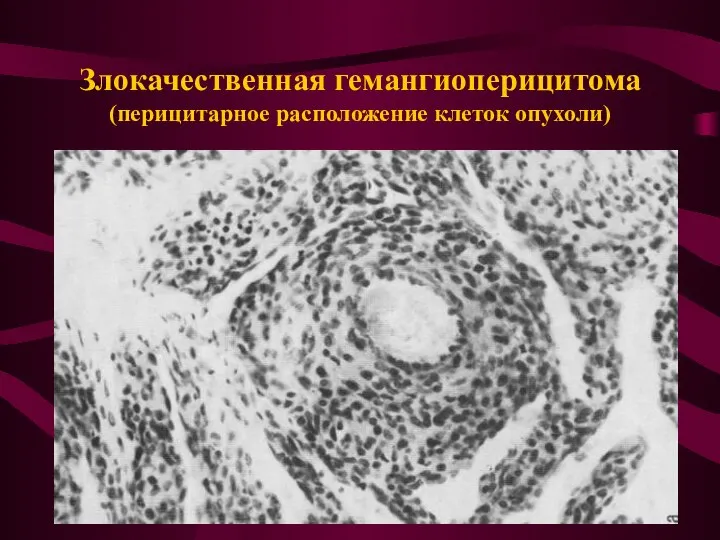 Злокачественная гемангиоперицитома (перицитарное расположение клеток опухоли)