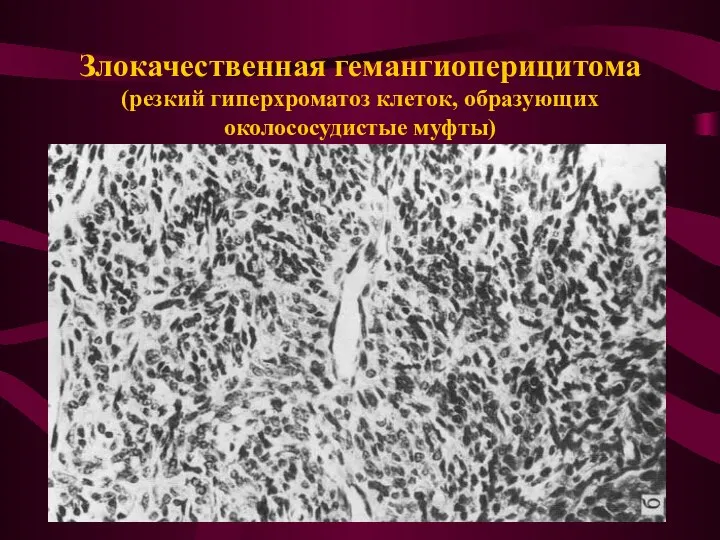 Злокачественная гемангиоперицитома (резкий гиперхроматоз клеток, образующих околососудистые муфты)