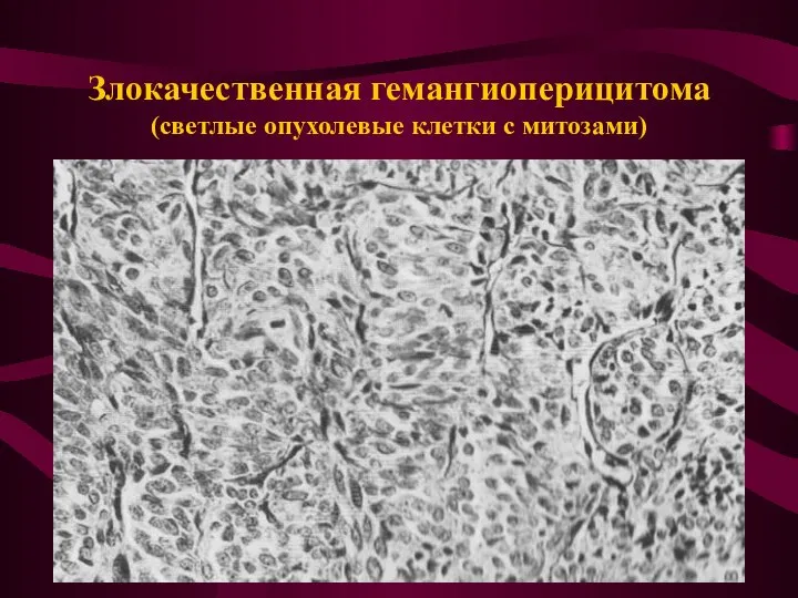 Злокачественная гемангиоперицитома (светлые опухолевые клетки с митозами)