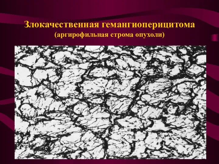 Злокачественная гемангиоперицитома (аргирофильная строма опухоли)