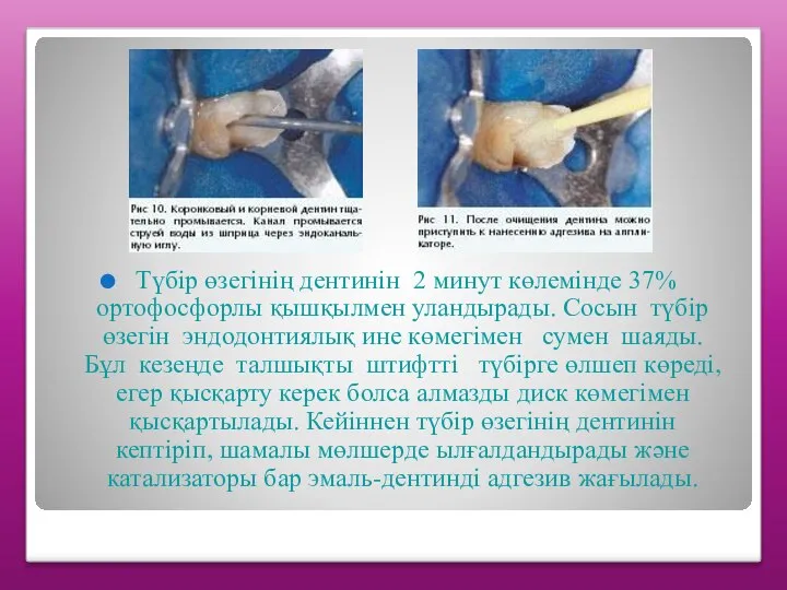 Түбір өзегінің дентинін 2 минут көлемінде 37% ортофосфорлы қышқылмен уландырады. Сосын түбір