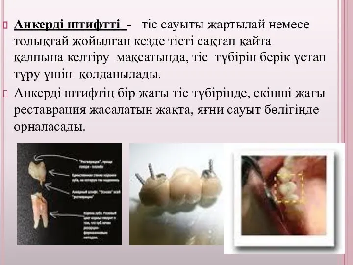 Анкерді штифтті - тіс сауыты жартылай немесе толықтай жойылған кезде тісті сақтап