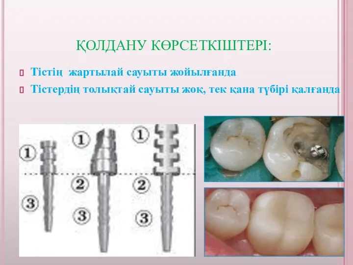 ҚОЛДАНУ КӨРСЕТКІШТЕРІ: Тістің жартылай сауыты жойылғанда Тістердің толықтай сауыты жоқ, тек қана түбірі қалғанда