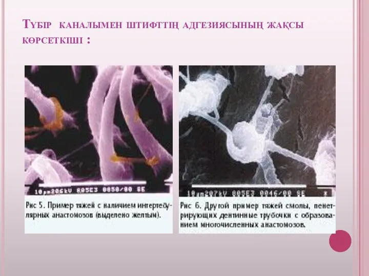 Түбір каналымен штифттің адгезиясының жақсы көрсеткіші :