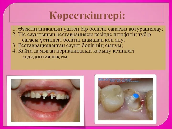 Көрсеткіштері: 1. Өзектің апикальді үштен бір бөлігін сапасыз абтурациялау; 2. Тіс сауытының