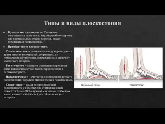 Типы и виды плоскостопия Врожденное плоскостопие. Связанно с нарушениями развития во внутриутробном