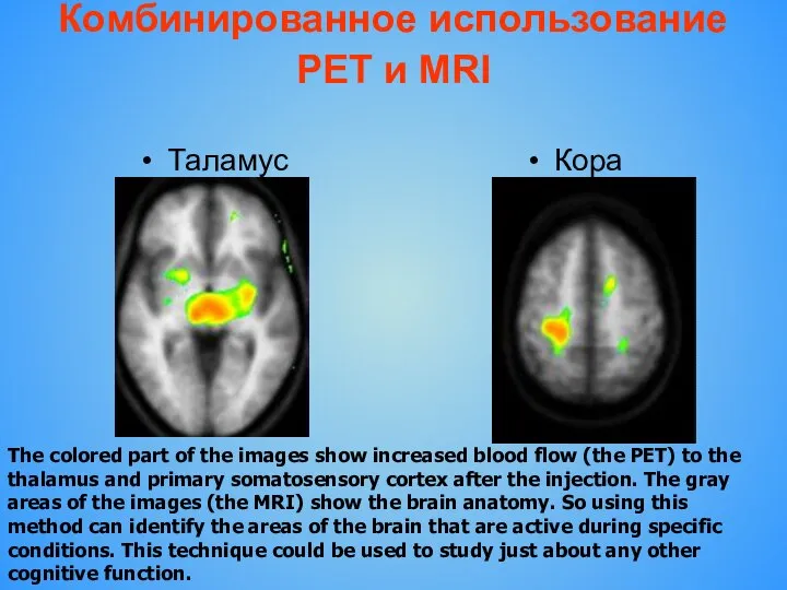 Комбинированное использование PET и MRI Таламус Кора The colored part of the