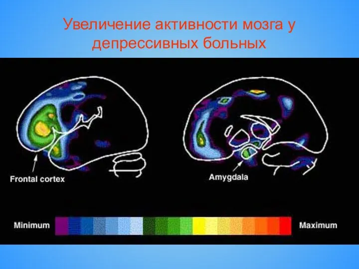 Увеличение активности мозга у депрессивных больных