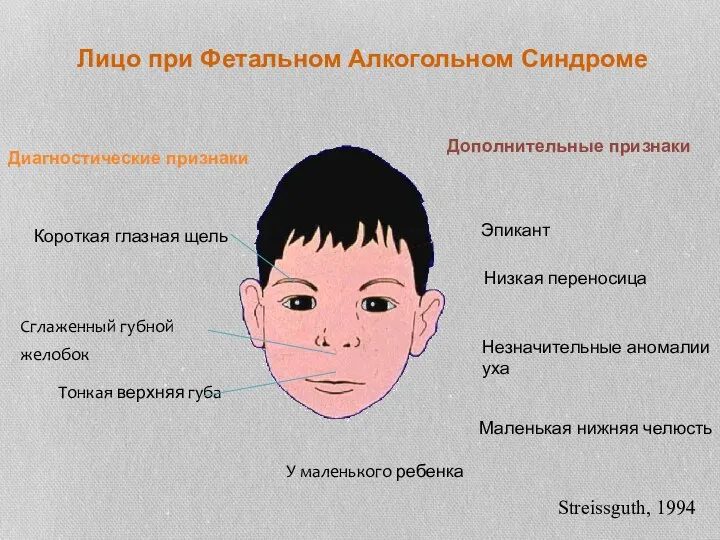 Лицо при Фетальном Алкогольном Синдроме Диагностические признаки У маленького ребенка Streissguth, 1994