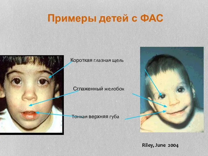 Примеры детей с ФАС Короткая глазная щель Сглаженный желобок Тонкая верхняя губа Riley, June 2004