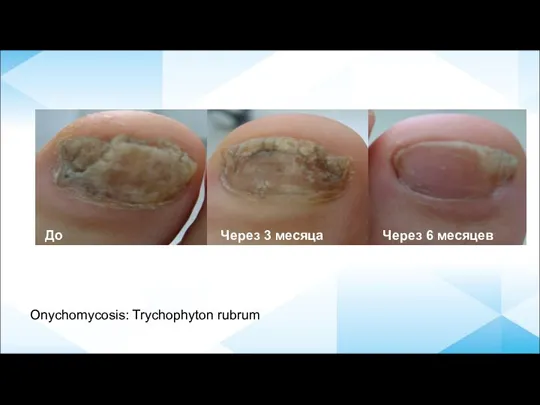 Before After 12 months До Через 3 месяца Через 6 месяцев Onychomycosis: Trychophyton rubrum