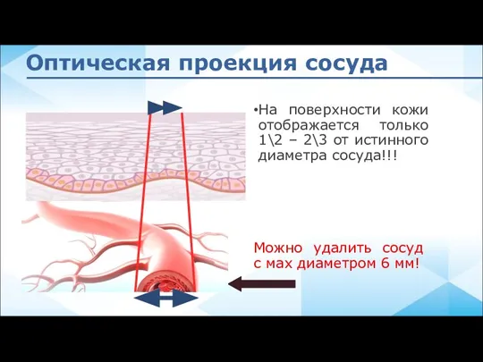 Оптическая проекция сосуда Можно удалить сосуд с мах диаметром 6 мм! На