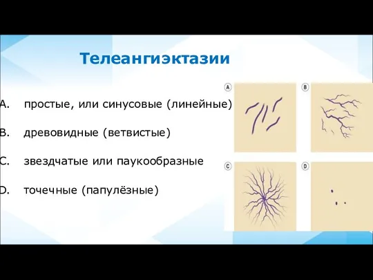 Телеангиэктазии простые, или синусовые (линейные) древовидные (ветвистые) звездчатые или паукообразные точечные (папулёзные)