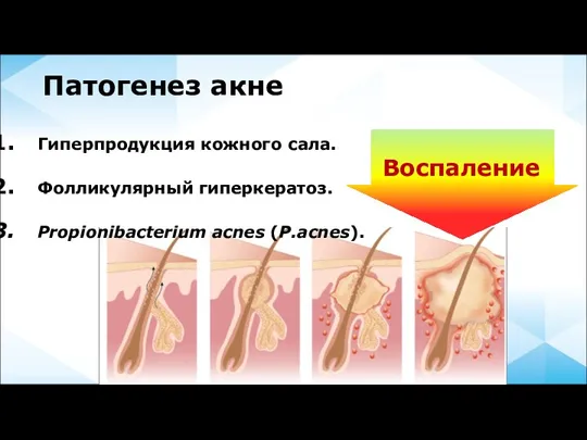 Патогенез акне Гиперпродукция кожного сала. Фолликулярный гиперкератоз. Propionibacterium acnes (P.acnes). Воспаление