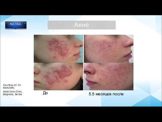 До Courtesy of: Dr. Radulaški, Nada Diva Clinic, Belgrade, Serbia 5.5 месяцев после Акне