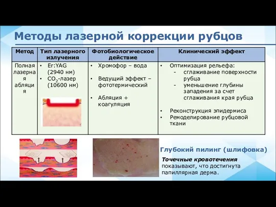 Методы лазерной коррекции рубцов Точечные кровотечения показывают, что достигнута папиллярная дерма. Глубокий пилинг (шлифовка)